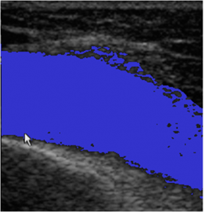 Ultrasound Patient A - Inflated - Highlighted