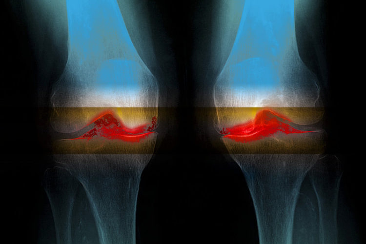 6,000-Year-Old Knee Joints Suggest Osteoarthritis Isn’t Just Wear And Tear